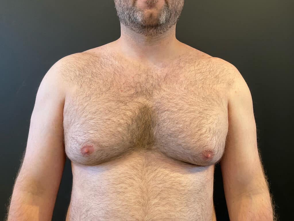 Before Image: Gynecomastia - front