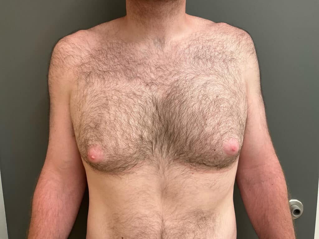 Before Image: Gynecomastia - front