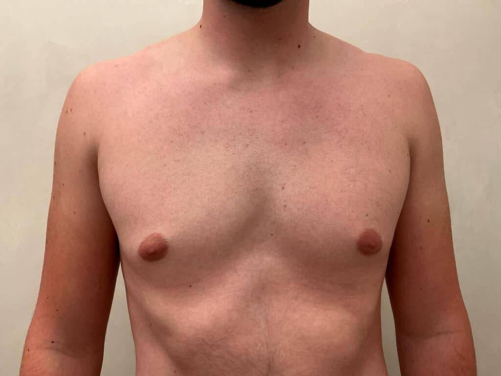 Before Image: Gynecomastia - front