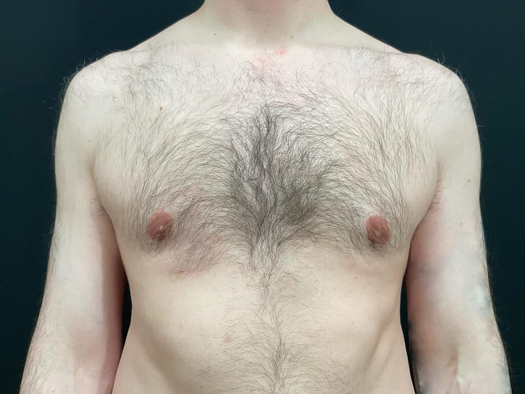 After Image: Gynecomastia - front