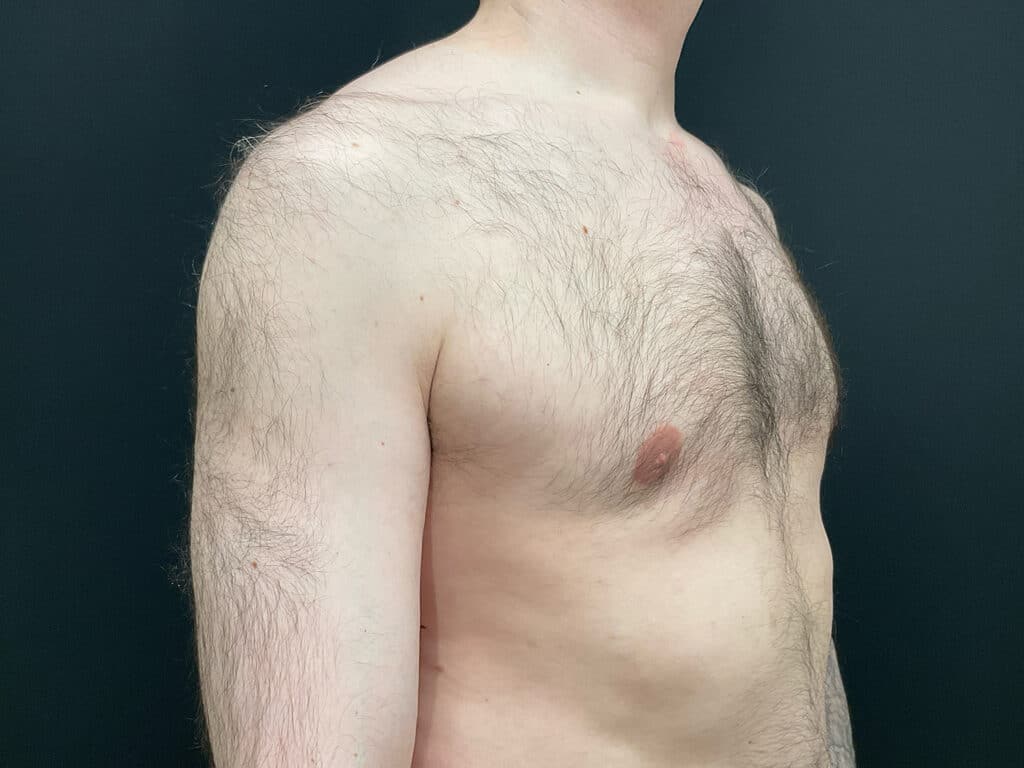 After Image: Gynecomastia - right-front-oblique
