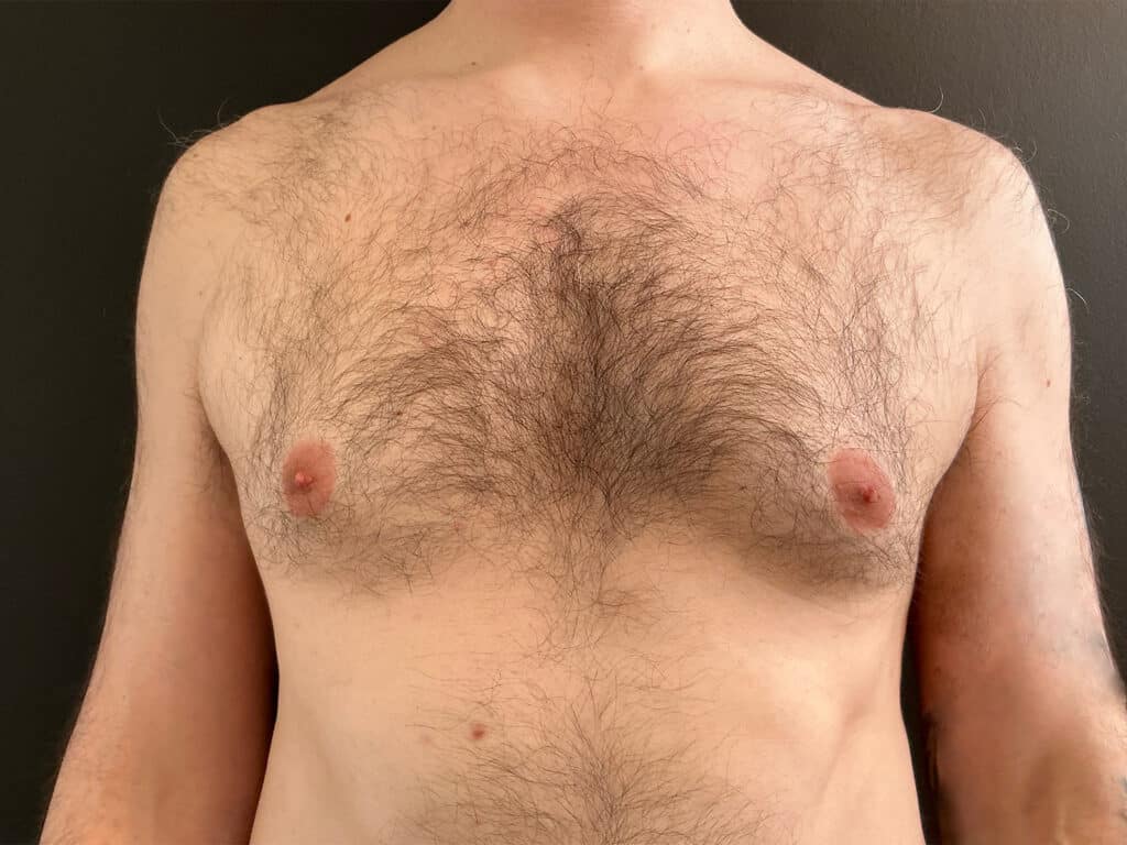 Before Image: Gynecomastia - front