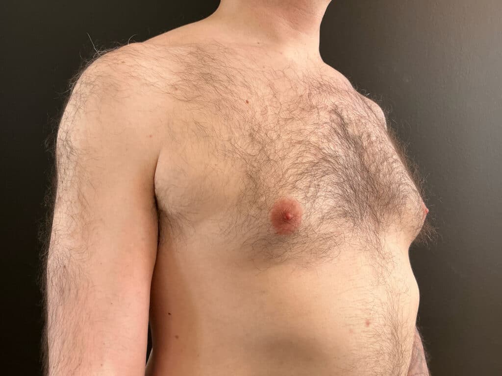Before Image: Gynecomastia - right-front-oblique