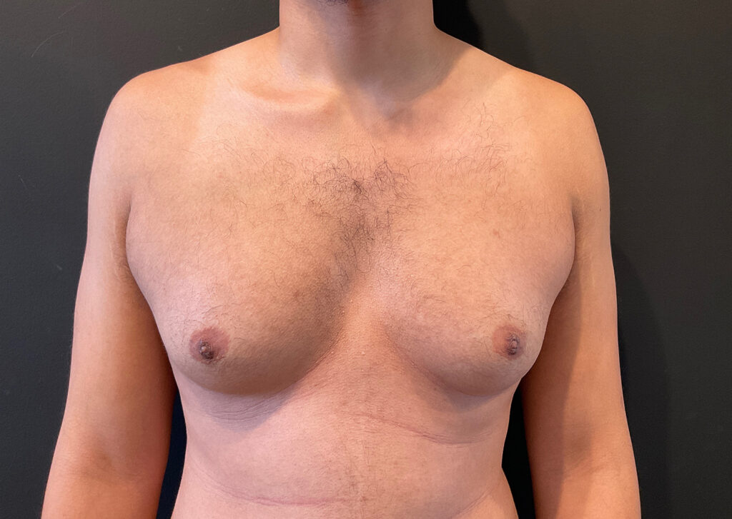 Before Image: Gynecomastia - front
