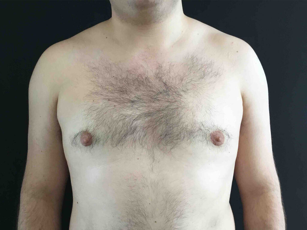 After Image: Gynecomastia - front