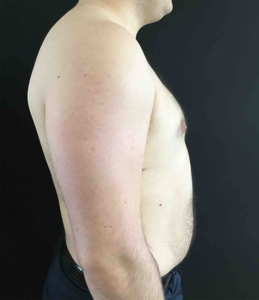 After Image: Gynecomastia - right-side