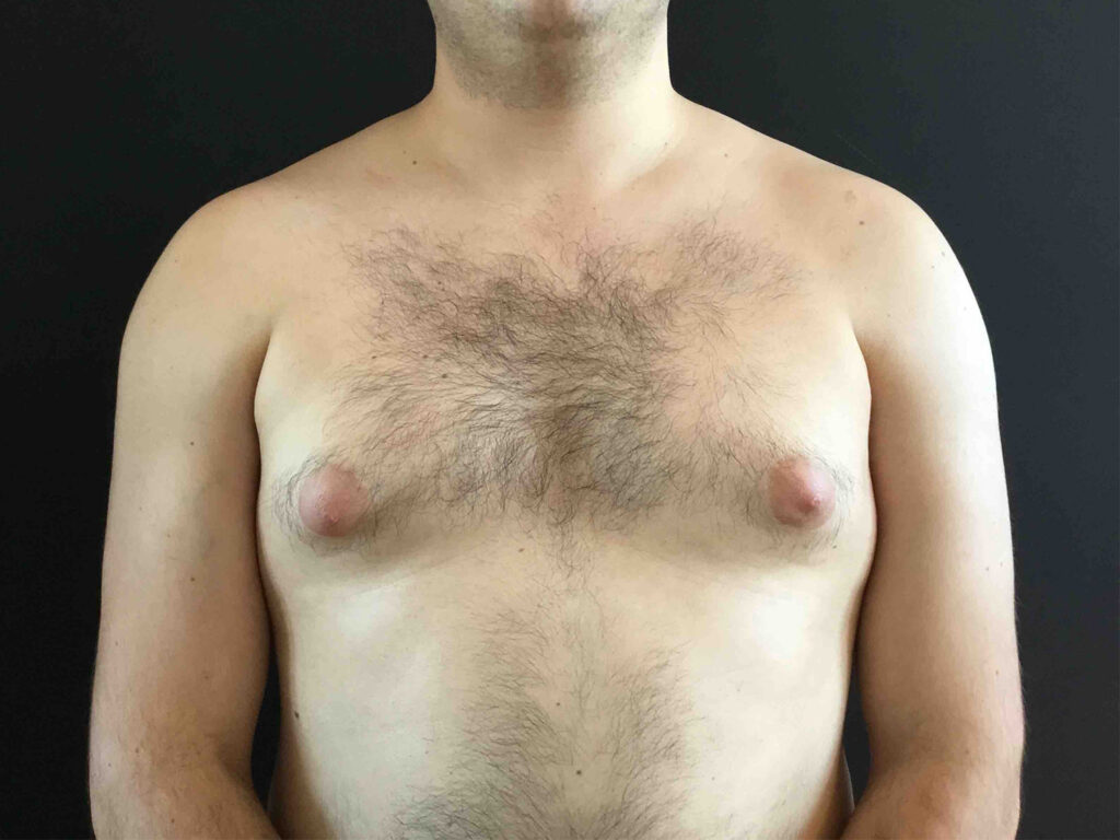 Before Image: Gynecomastia - front