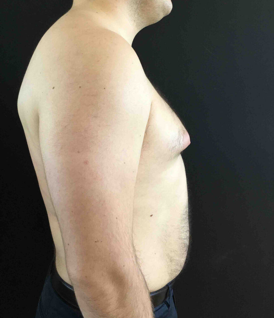 Before Image: Gynecomastia - right-side
