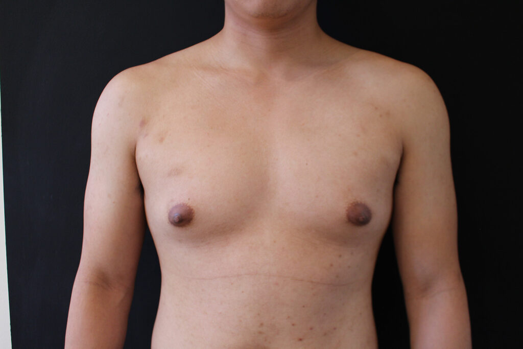 Before Image: Gynecomastia - front