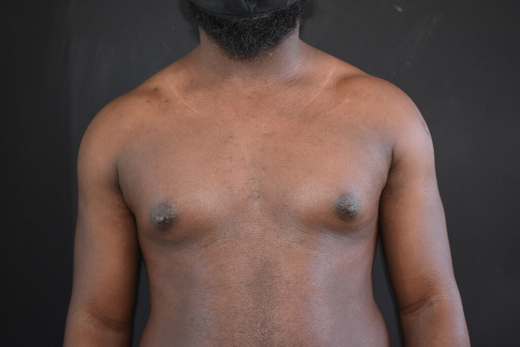 Before Image: Gynecomastia - front